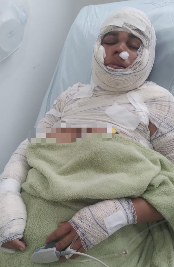 Mulher é agredida por "companheiro" com água fervente no Entroncamento de Jaguaquara-Ba.